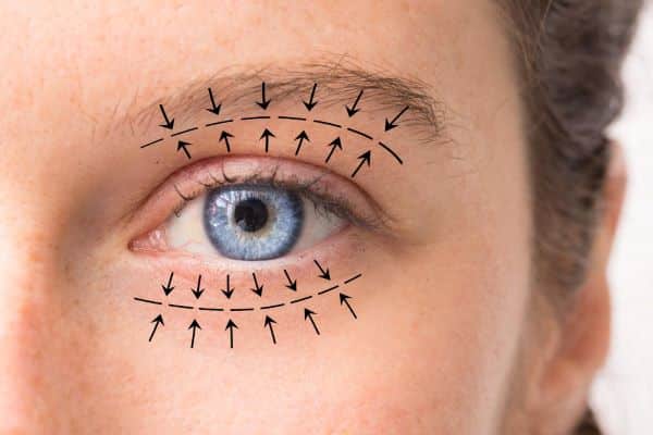 marcações nos olhos de paciente que vai realizar cirurgia de pálpebras