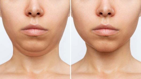 Rejuvenescimento: antes e depois de realização de lifting na face para eliminar sinais de envelhecimento facial.  